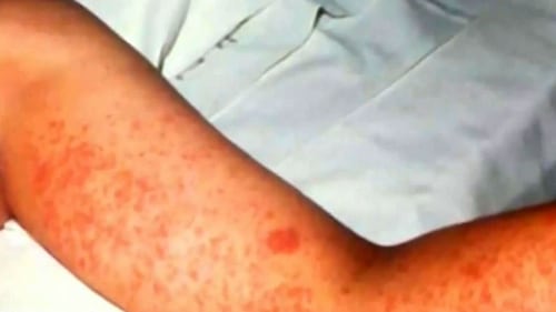 Baby in Sudbury area has the measles, first case since 2014