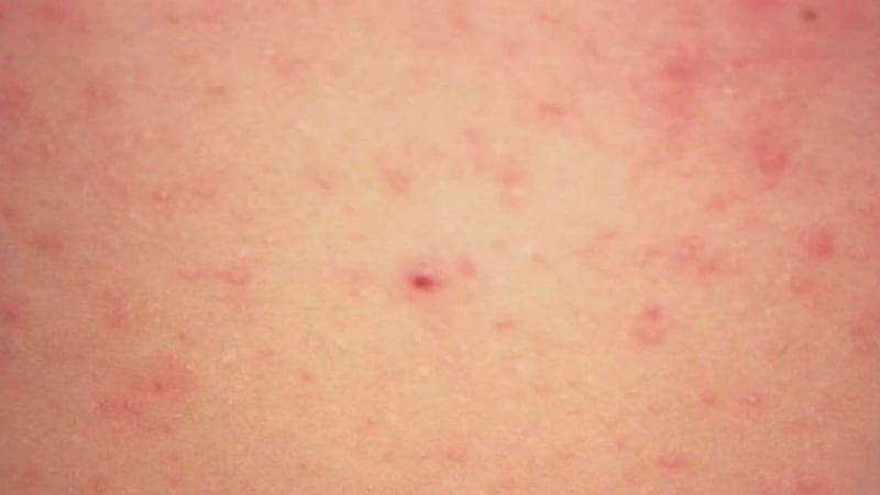 Dozens more measles cases confirmed, Sudbury health unit warns of exposure on Chi-Cheemaun ferry