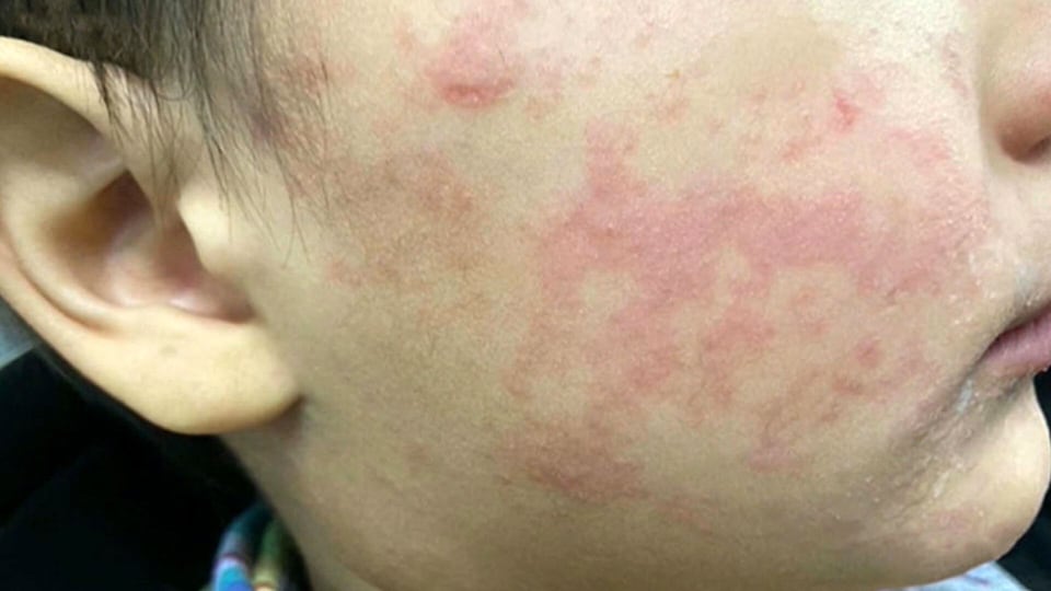CTV National News: What is driving measles outbreaks in Canada?