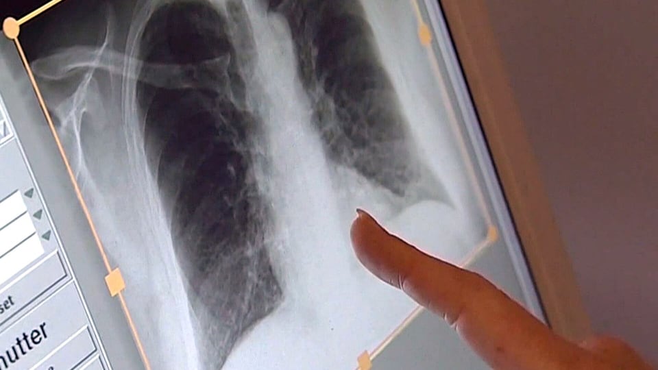 Tuberculosis third highest disease in Windsor