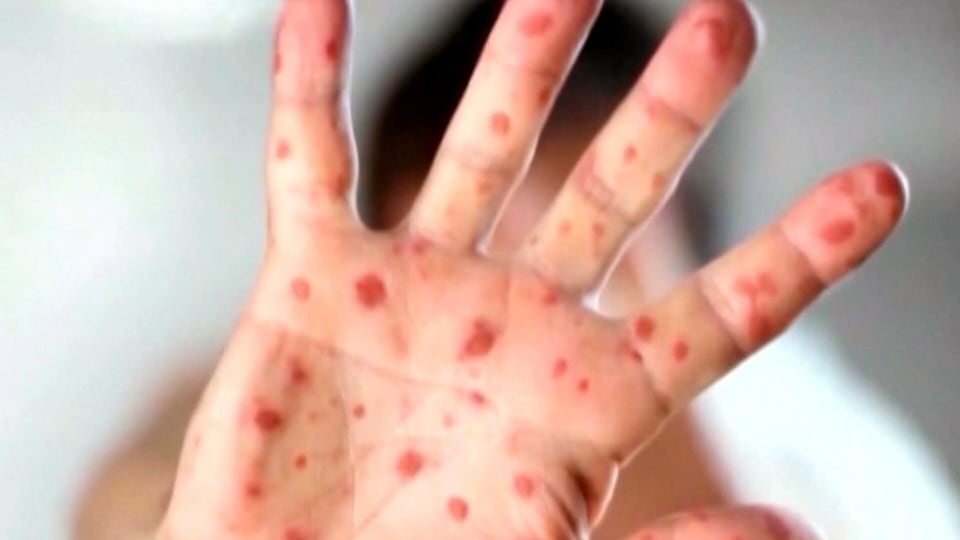 Province defends measles response
