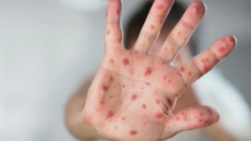 What the public needs to know about measles as cases rise