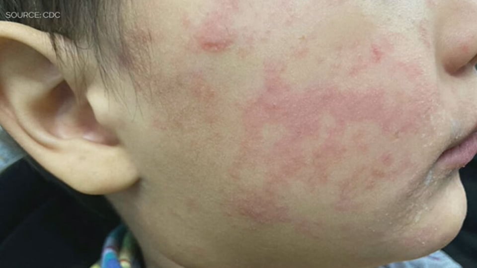 Province reacts with campaign, clinic access as measles cases spike