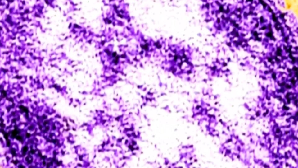 Ontario child dies after contracting measles