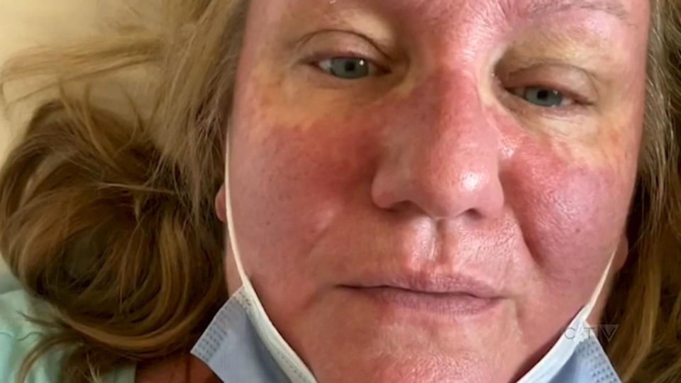 CTV National News: Sask. woman on how the measles put her in hospital