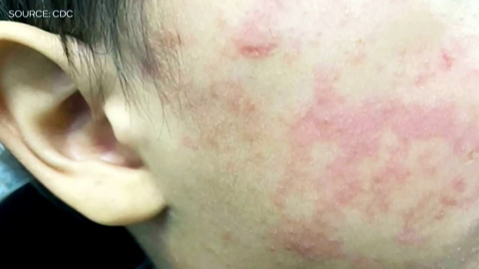 Medical experts urging Albertans to protect themselves against measles